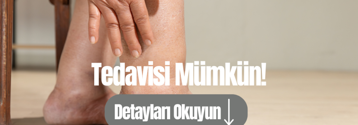 Kalın Bacaklarınızın Sorumlusu Lipödem Olabilir