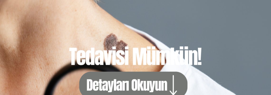 Papillom nedir? Baş Boyun Bölgesinde nerelerde görülür ?