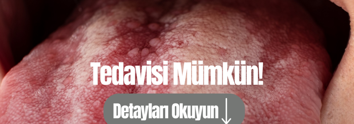 Dil Kanseri Nedir?