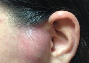 Brankiyal Yarık Kistleri ve Çeşitleri Nelerdir ?